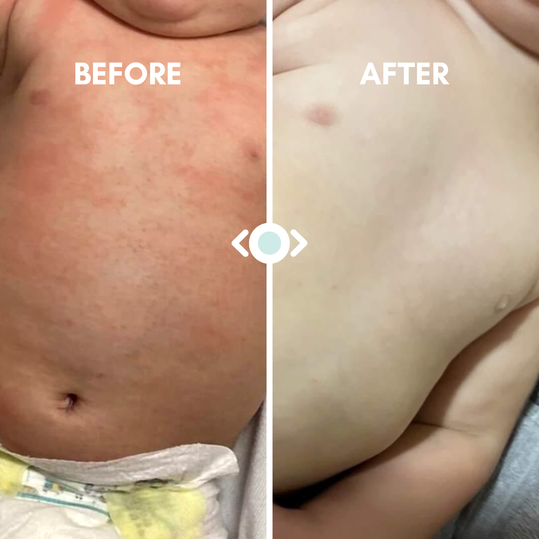 Eczema Relief Balm